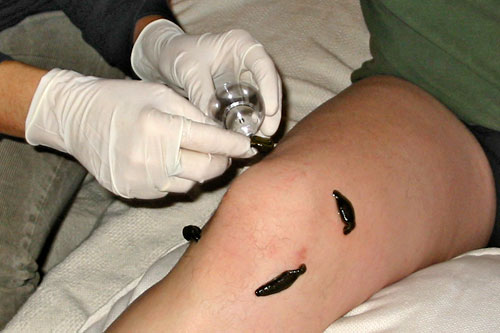 Behandlung Blutegel Knie